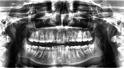 Panoramic dental X-Ray