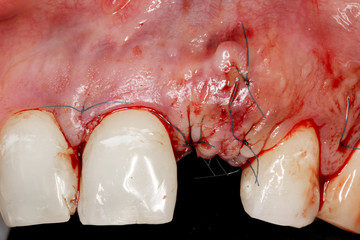 Dental surjery implant view