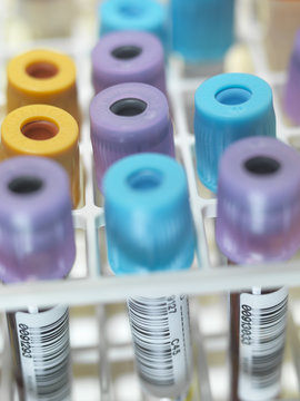 A row of human blood and chemistry samples awaiting testing in the lab