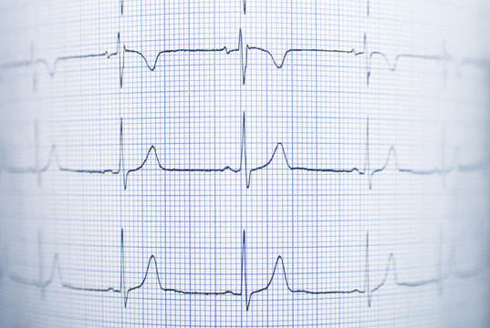 Healthy electrocardiogram