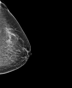 Breast Mammography, X-ray of woman's breast for early identification of breast cancer
