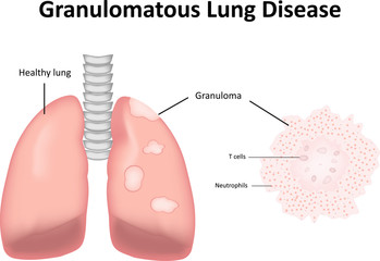 Obraz premium Granulomatous Lung Disease Labeled