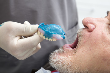 Repair of the upper jaw prosthesis insertion