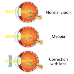 Myopia and myopia corrected by a minus lens. - obrazy, fototapety, plakaty