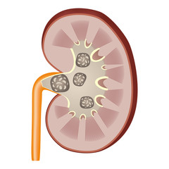Kidney stones illustration.
