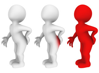 3d man with hemorrhoids