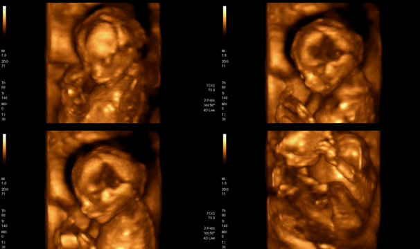 Medical images collage of 4D ultrasound during woman pregnancy s