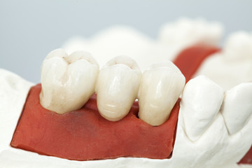 Fototapeta na wymiar Metal free ceramic dental crowns