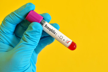 Obraz premium Blood sample positive with hemophilia