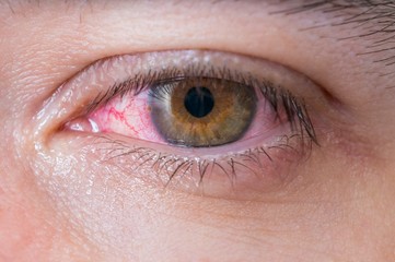 Macro of conjunctivitis red eye. - obrazy, fototapety, plakaty