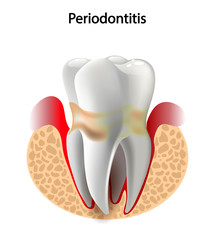 vector image tooth  Periodontitis disease