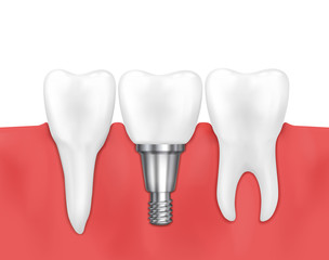 Dental implant and normal tooth vector illustration