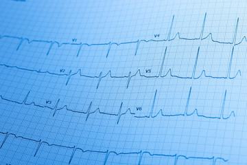 Electrocardiogram / ECG printed on graph paper.

A healthy ECG printed on white graph paper used...