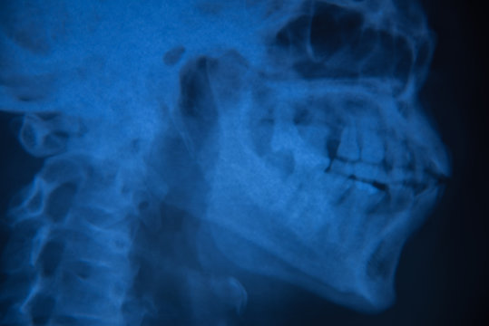 View of  film x-ray skull of human