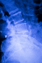 Spine back metal implant xray scan