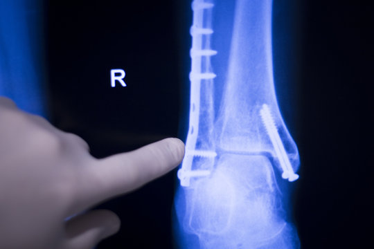 Foot ankle metal implant xray scan