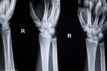 Wrist hand injury xray scan