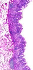 Obraz premium Chronic gastritis of a human