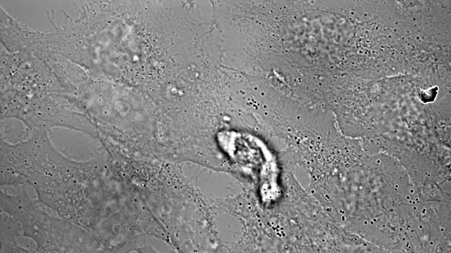 Movement, division and death of HeLa cervical cancer cells under microscope
