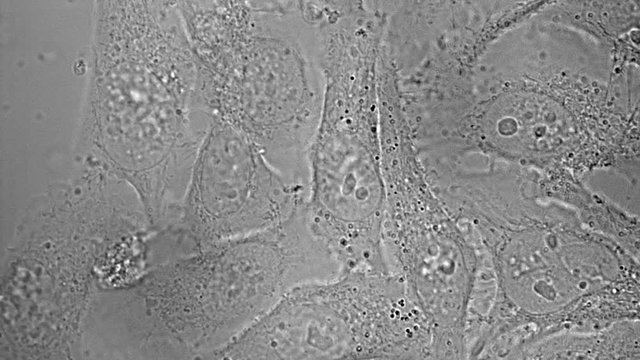 Movement, division and death of HeLa cervical cancer cells under microscope
