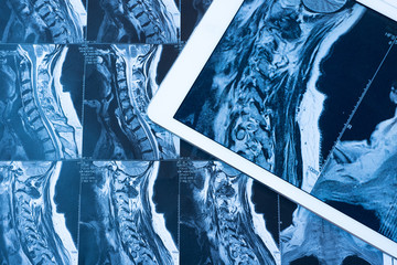 MRI Pictures of spinal column with magnification on overlaying t