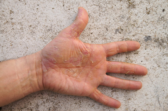 rissige Hand Neurodermitis mit gleichsam rissigem Hintergrund