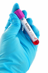 Obraz premium Blood sample positive with acetone chemical testing 