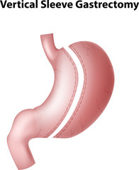 Illustration of vertical sleeve gastrectomy