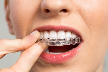 Smiling Woman with silicone trainer