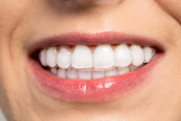 Naklejka premium Woman wearing orthodontic silicone trainer