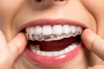 Obraz premium Wearing orthodontic silicone trainer