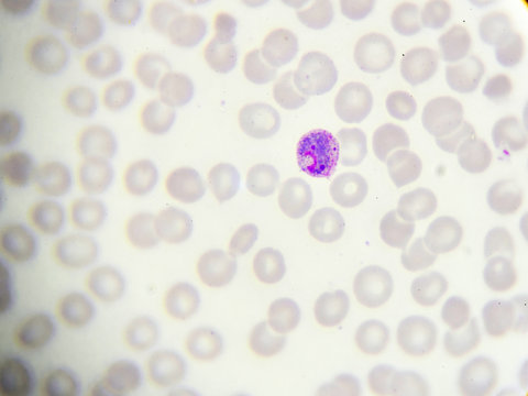 Malaria parasite (gametocyte stage) in peripheral blood smear
