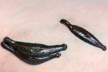 Leeches on human skin. Hirudotherapy varicose