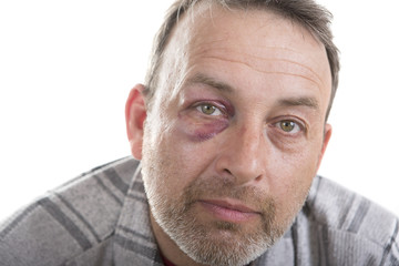 Obraz premium Middle-aged Caucasian male Emotional Portrait with a Real Bruise