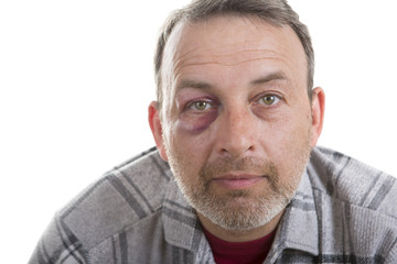 Middle-aged Caucasian male Emotional Portrait with a Real Bruise