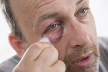 Obraz premium Middle-aged Caucasian male Emotional Portrait with a Real Bruise