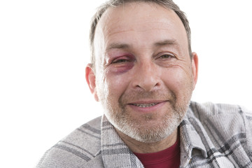Obraz premium Middle-aged Caucasian male Emotional Portrait with a Real Bruise