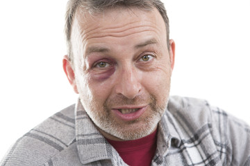 Middle-aged Caucasian male Emotional Portrait with a Real Bruise