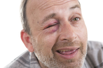 Middle-aged Caucasian male Emotional Portrait with a Real Bruise