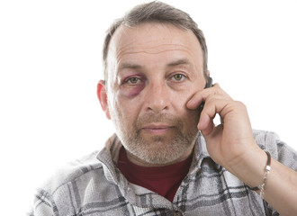 Middle-aged Caucasian male Emotional Portrait with a Real Bruise