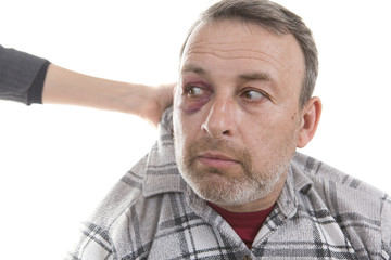 Obraz premium Middle-aged Caucasian male Emotional Portrait with a Real Bruise