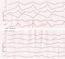 Tape ECG with idioventricular rhythm (