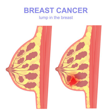 sectional tumor and breast cancer