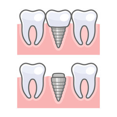Dental Implant and Tooth Set. Vector