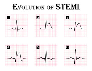 ECG of evolution ( step by step ) of STEMI ( ST elevation myocardial infarction ) Acute coronary syndrome , angina pectoris