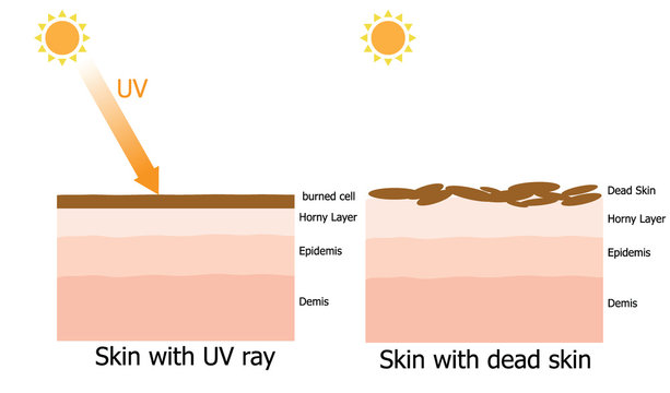 Cause of dead skin in human skin in summer
