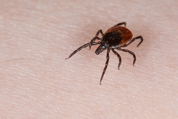 Holzbock Zecke (Ixodes ricinus) auf menschlicher Haut