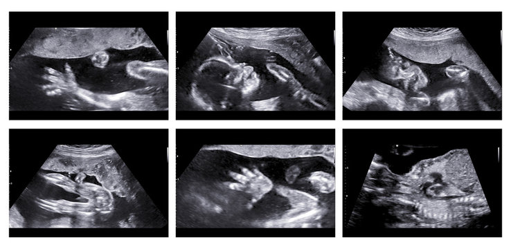 Collage of medical images of ultrasound anomaly scan on a female