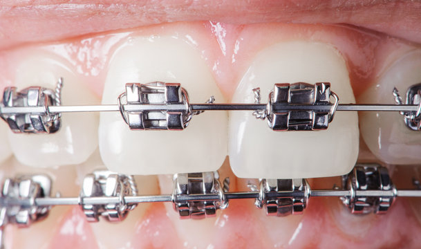 Close-up dental braces on teeth. Orthodontic Treatment. Dental care Concept. Extreme macro