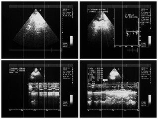 Cardiac ultrasound images, color Doppler echo